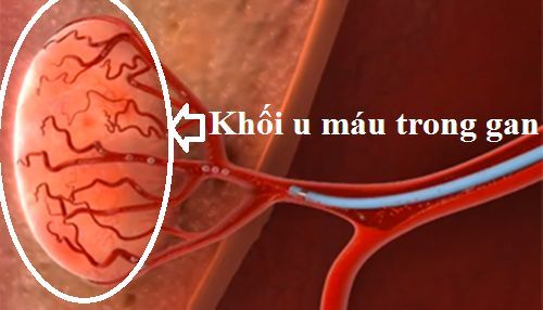 Hình ảnh khối u máu trong gan.