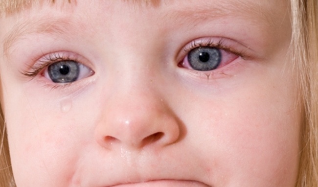 Chữa viêm màng bồ đào ở trẻ em thế nào?