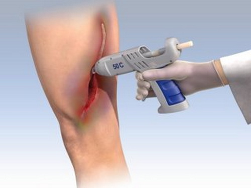 Súng bắn gel - bước tiến thần kỳ trong y học.