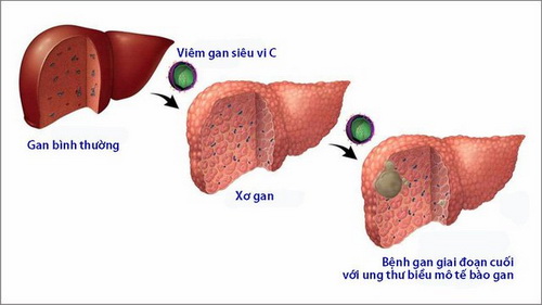 Nếu không được chữa trị kịp thời, viêm gan virut C có thể dẫn tới các bệnh nguy hiểm.