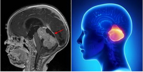 U nguyên bào tủy (medulloblastoma).