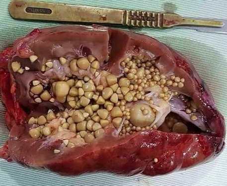 Hình ảnh bên trong quả thận của một bệnh nhân.
