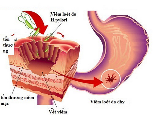 Viêm dạ dày cấp tính - một bệnh dễ gặp khi đi du lịch.