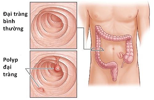 Polyp đại trực tràng có thành ung thư?