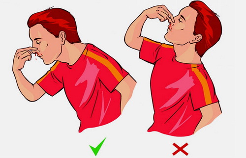 Sơ cứu chảy máu mũi đúng (trái) và sai (phải).
