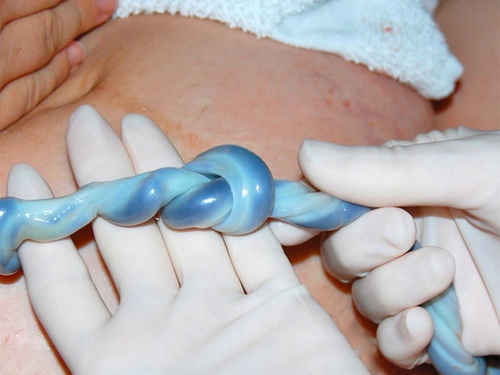 Dây rốn thắt nút: Mối nguy với thai nhi và thai phụ