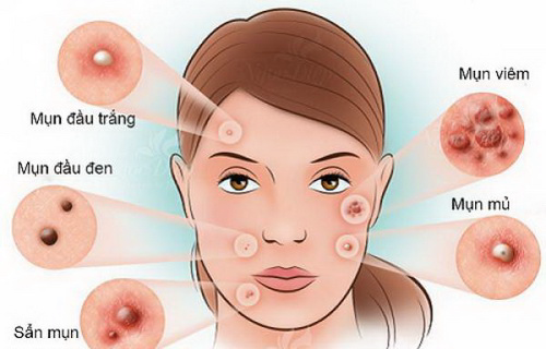 Mụn trứng cá là một trong những bệnh lý về da phổ biến nhất.