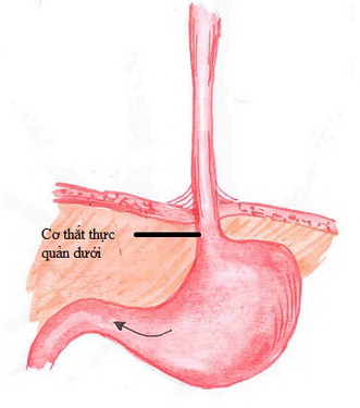 Hình ảnh co thắt thực quản dưới.