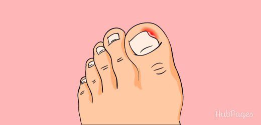Móng mọc ngược gây đau xử trí thế nào?- Ảnh 3.
