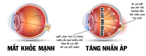 Hình ảnh mắt bị tăng nhãn áp.