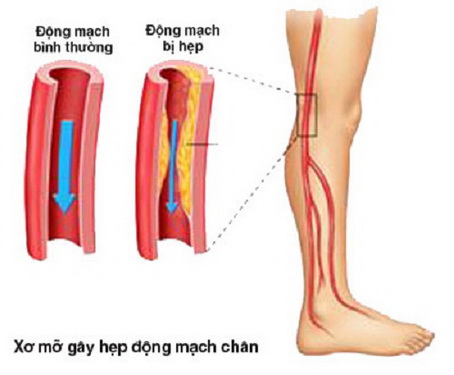 Xơ mỡ - một nguyên nhân gây hẹp động mạch chân.