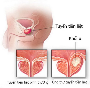 Hình ảnh ung thư tuyến tiền liệt.