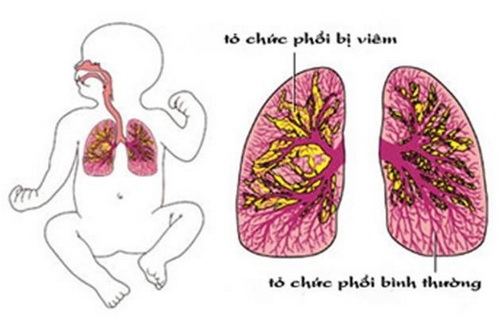 Viêm phổi nặng là biến chứng của bệnh sởi.