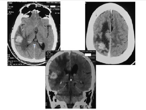 Hình CT scan sọ não cản quang của bệnh nhân lúc nhập viện.