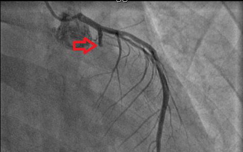 Hình ảnh chụp mạch vành sau khi bệnh nhân 25 tuổi được đặt 1 stent.