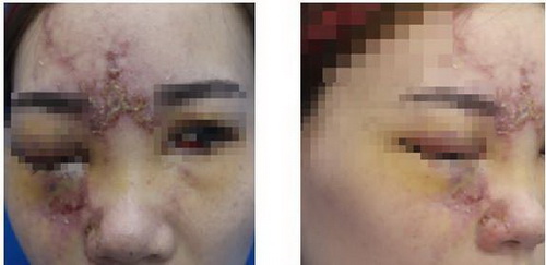 Nạn nhân do tiêm filler làm đầy tại cơ sở không có chuyên môn.