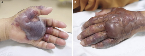 Tay của người nhiễm khuẩn Vibrio vulnificus.