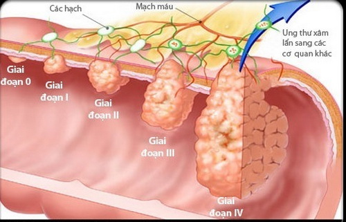 Các giai đoạn của ung thư đại tràng.