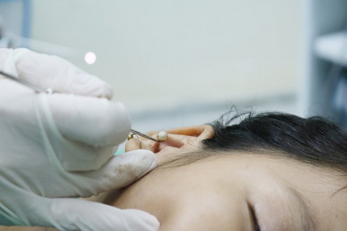 Dị vật lấy ra khỏi tai bé là chiếc hạt đồ chơi.