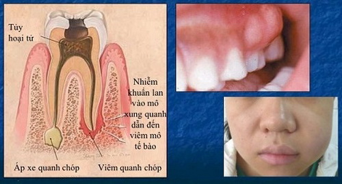 Hình ảnh viêm quanh cuống răng.