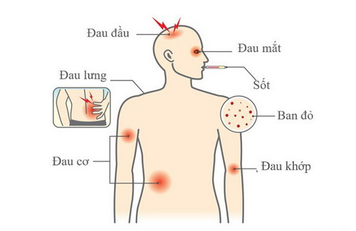 Các triệu chứng của sốt xuất huyết.