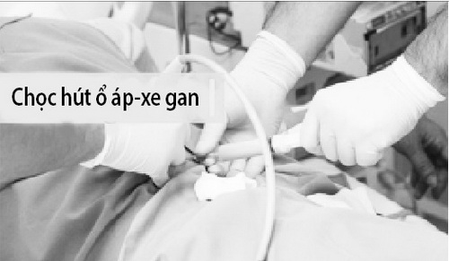 Ổ áp-xe gan nếu không được xử lý sớm có thể gây ra nhiễm khuẩn huyết nghiêm trọng.