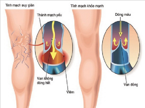 Viêm tắc tĩnh mạch chi chủ yếu là do khí huyết không được lưu thông.