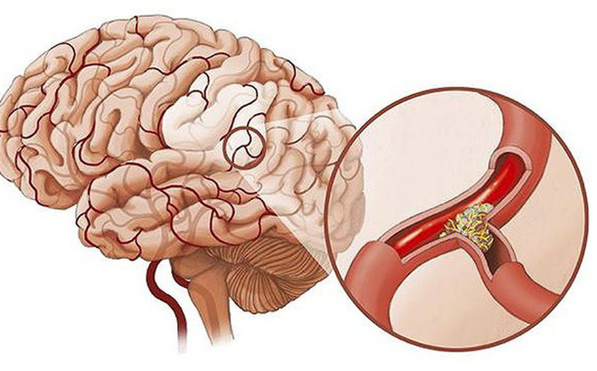 Dinh dưỡng cho người thiếu máu não