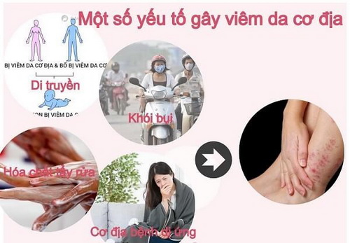 Bệnh viêm da cơ địa thường xuất hiện khi thời tiết hanh khô, mọi người cần chú ý phòng tránh.