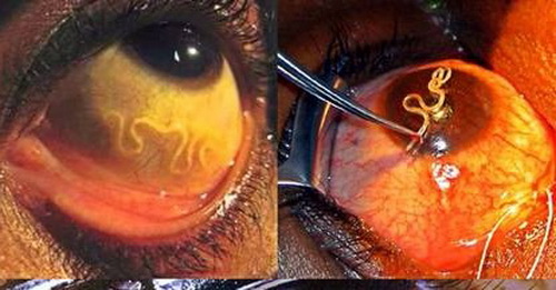 Ký sinh trùng sống ký sinh hay lạc chỗ trong mắt người bệnh.