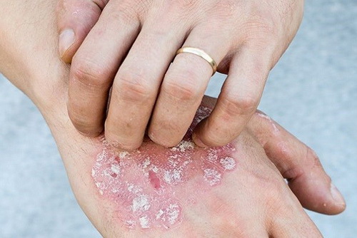 Ngứa là một phiền hà mà người bệnh vẩy nến thường phải đối mặt.