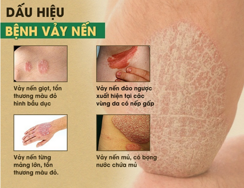 Dấu hiệu nhận biết bệnh vảy nến.