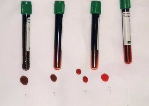 Trong ống 1 và 2, tỷ lệ methemoglobin là 70%; trong ống 3 là 20% và trong ống 4 là bình thường.