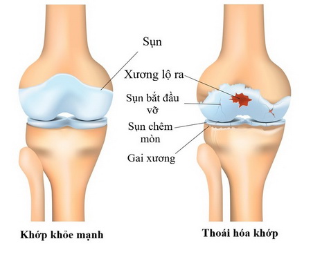 Hình ảnh thoái hóa khớp.