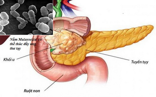 Nấm có thể từ ruột lên tụy và thúc đẩy ung thư.