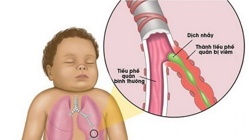 Hình ảnh viêm tiểu phế quản ở trẻ.