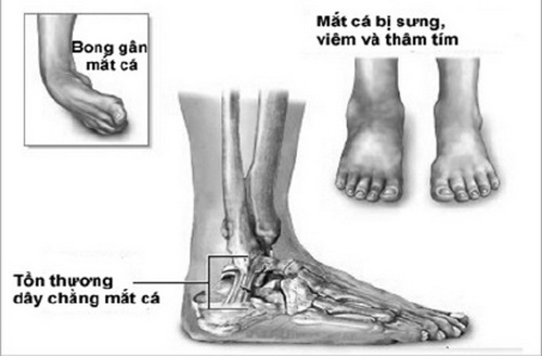 Các biểu hiện của bong gân.