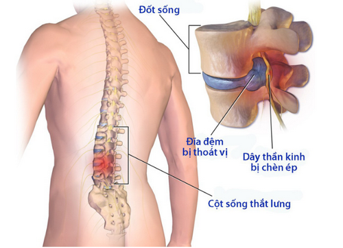 Thoát vị đĩa đệm vùng thắt lưng - đây là nguyên nhân chính của chèn ép vùng đuôi ngựa .