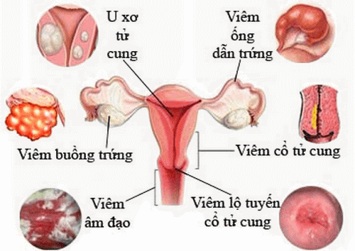 Các bệnh phụ khoa cần được chữa trị kịp thời để tránh biến chứng.