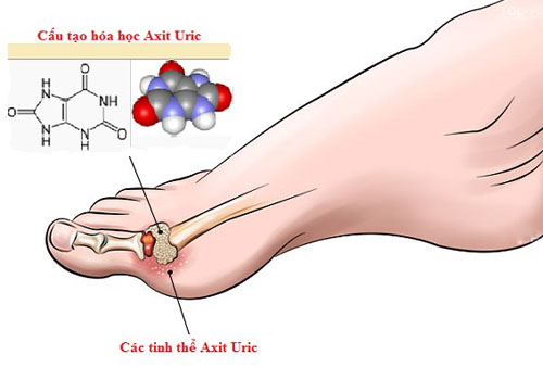 Các tinh thể axit uric lắng đọng tại các khớp.