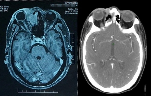 Hình ảnh MRI xoang trước và sau khi điều trị xạ.