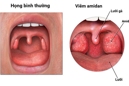 Viêm amidan thường gặp ở trẻ em, dễ tái đi tái lại. Nếu không được điều trị sớm và triệt để rất dễ dẫn đến viêm phế quản, phổi.