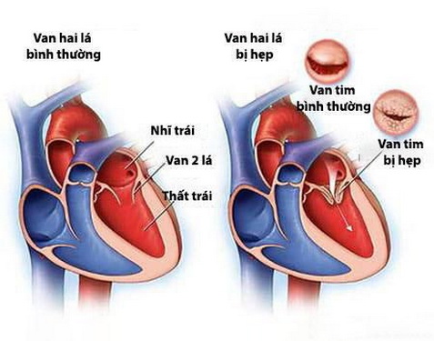 Hình ảnh van tim bình thường và van tim bị hẹp.