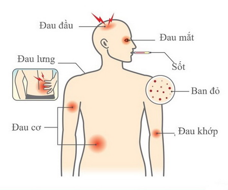 Dấu hiệu và triệu chứng sốt xuất huyết.
