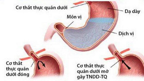 Hình ảnh thực quản bị co thắt.