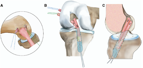 Phẫu thuật điều trị đứt dây chằng chéo trước