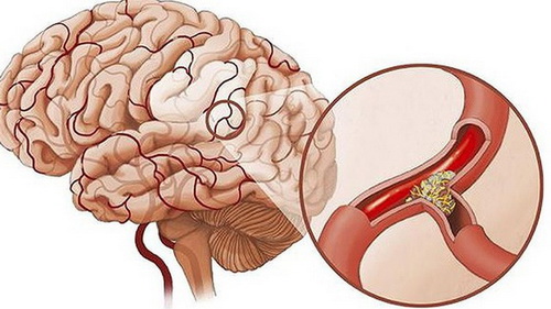Mạch máu não bị tắc nghẽn là một trong những nguyên nhân gây thiểu năng tuần hoàn não.