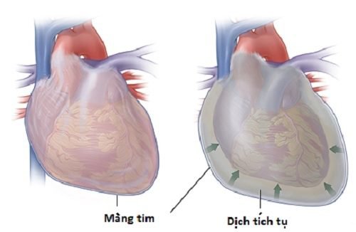 Hình ảnh viêm màng ngoài tim co thắt.