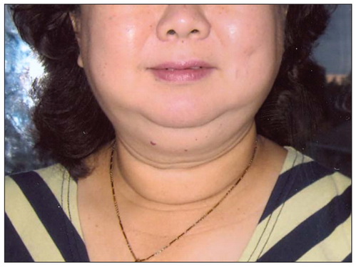 Cảnh giác với thuốc tăng cân chứa corticoid gây hội chứng Cushing.