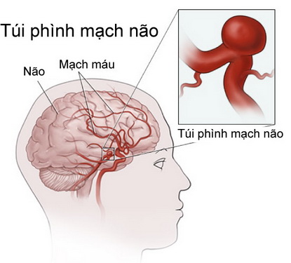 Phình mạch não thường gặp tại các điểm phân nhánh của hệ mạch, phát triển lớn lên từ từ.